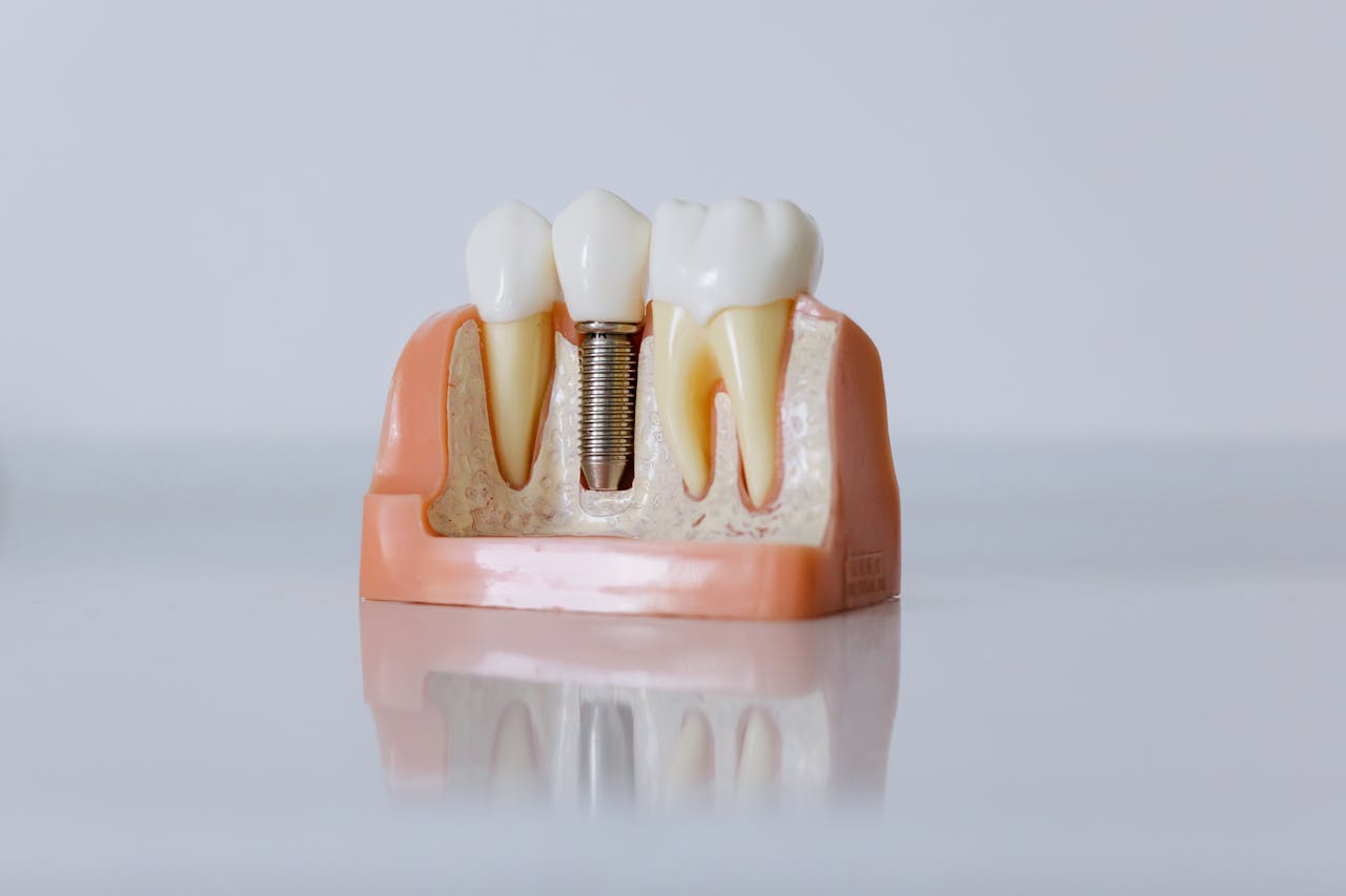 Zahlt die PKV für Zahnersatz & Implantate?